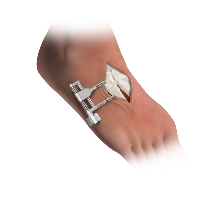 Illustration of a Treace medical fulcrum instrument being used to realign the metatarsal bone during a Lapiplasty bunion procedure.
