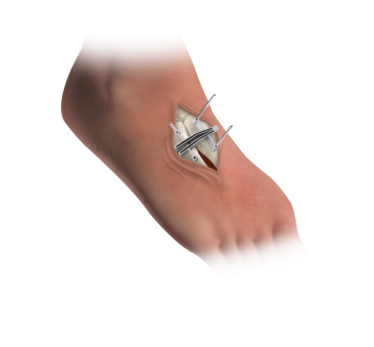 Illustration of a Treace surgical cut guide and alignment pins secured to the metatarsal joint during a bunion correction procedure.