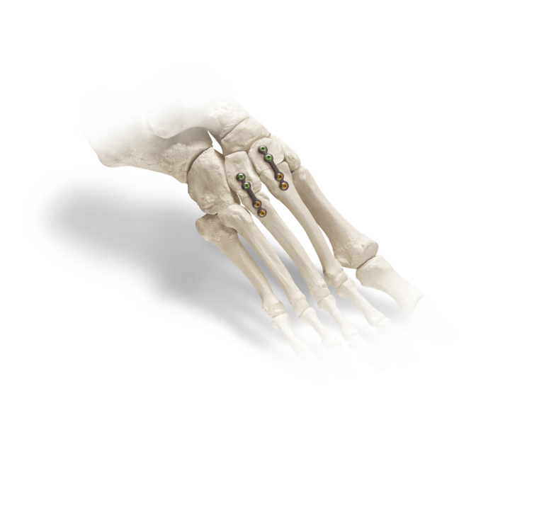 Two Treace medical bone plates and multicolored locking screws secured across the metatarsal joints of an anatomical foot bone model.