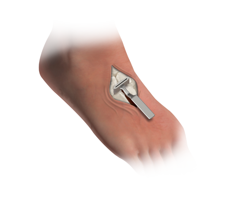 Illustration of a Treace surgical joint scraper being used on a human foot during a bunion correction procedure.