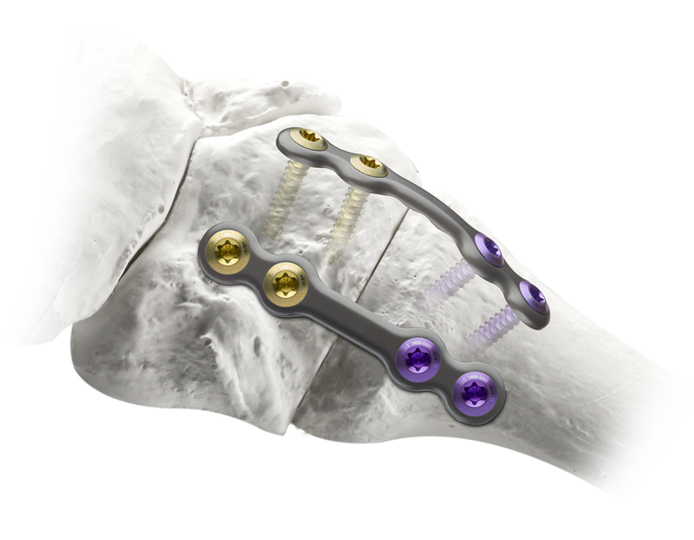 Two Treace medical bone plates and gold and purple locking screws secured across a joint on a white anatomical foot bone model.