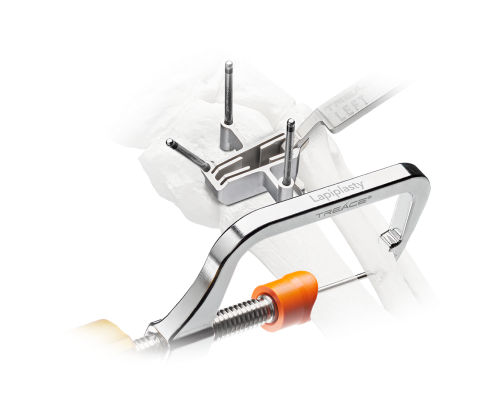 Surgical device attached to a bone model, showcasing Treace Medical's Lapiplasty technology for bunion correction.
