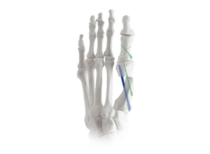 X-ray image of a human foot skeleton showing fractures in the toe bones with highlighted lines.