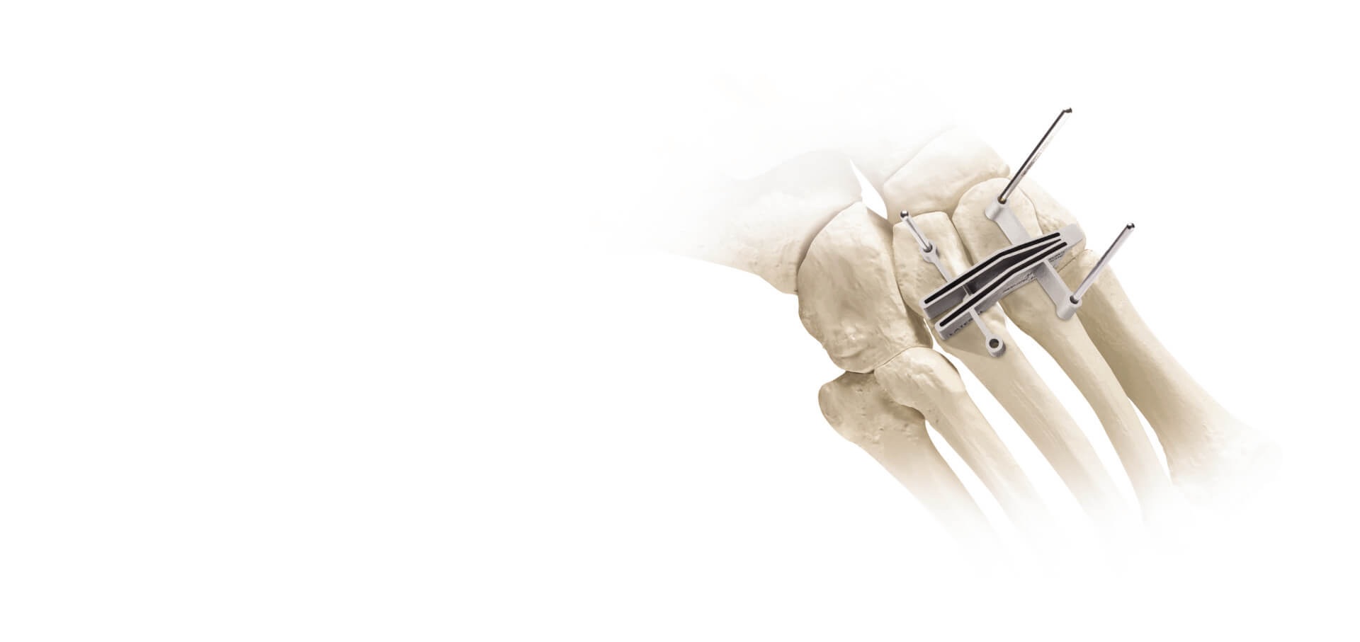 Treace surgical cut guide and alignment pins positioned on an anatomical foot bone model for precise bone preparation.