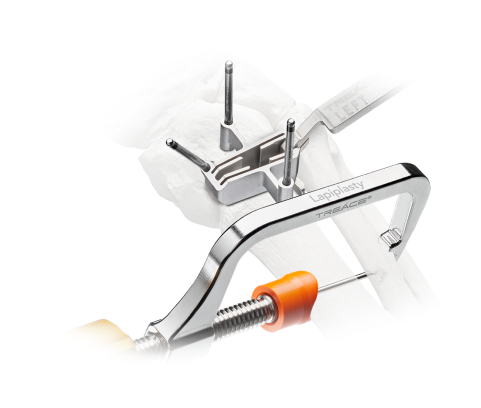 Surgical tool for bone alignment with orange knob and metal frame, shown with bone model.