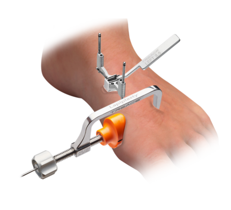 Treace Lapiplasty medical instrumentation and alignment guides positioned on a human foot for a bunion correction procedure.