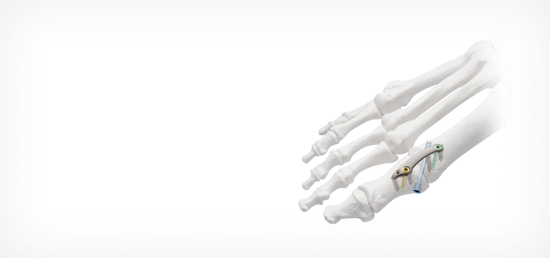 X-ray illustration of a foot with orthopedic implant on the metatarsal bone against a plain white background.