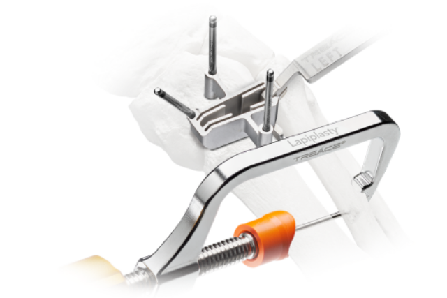 Treace Lapiplasty medical instrumentation and guides positioned on a foot bone model for a bunion correction procedure.