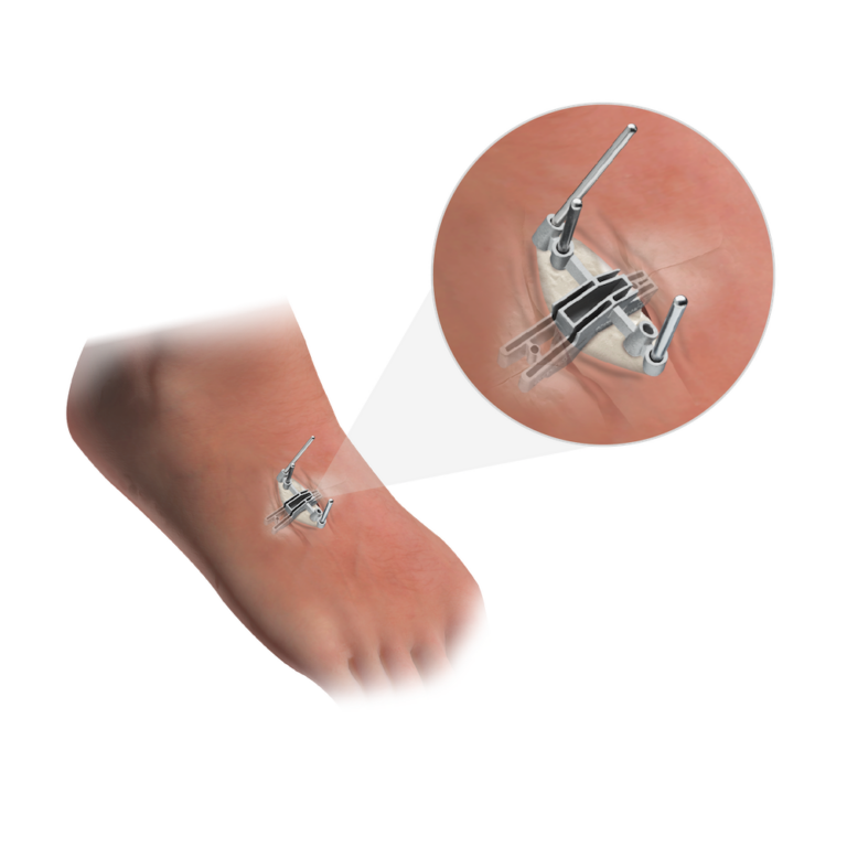 Illustration of a foot with a focus on a surgical implant inside, showing medical prosthetics and technology.