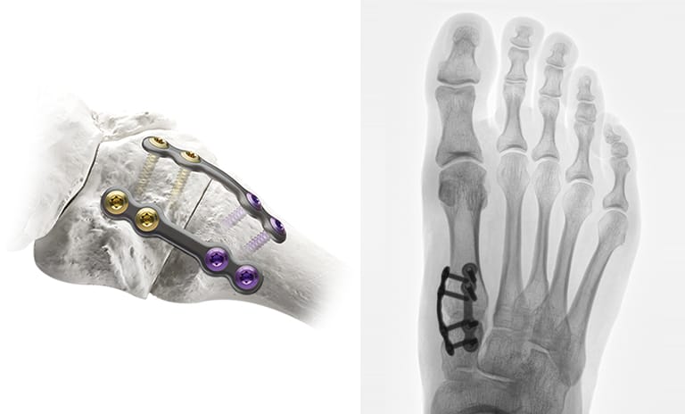 Side-by-side comparison of a 3D anatomical model and a medical X-ray showing Treace bone plates and screws secured for bunion correction.