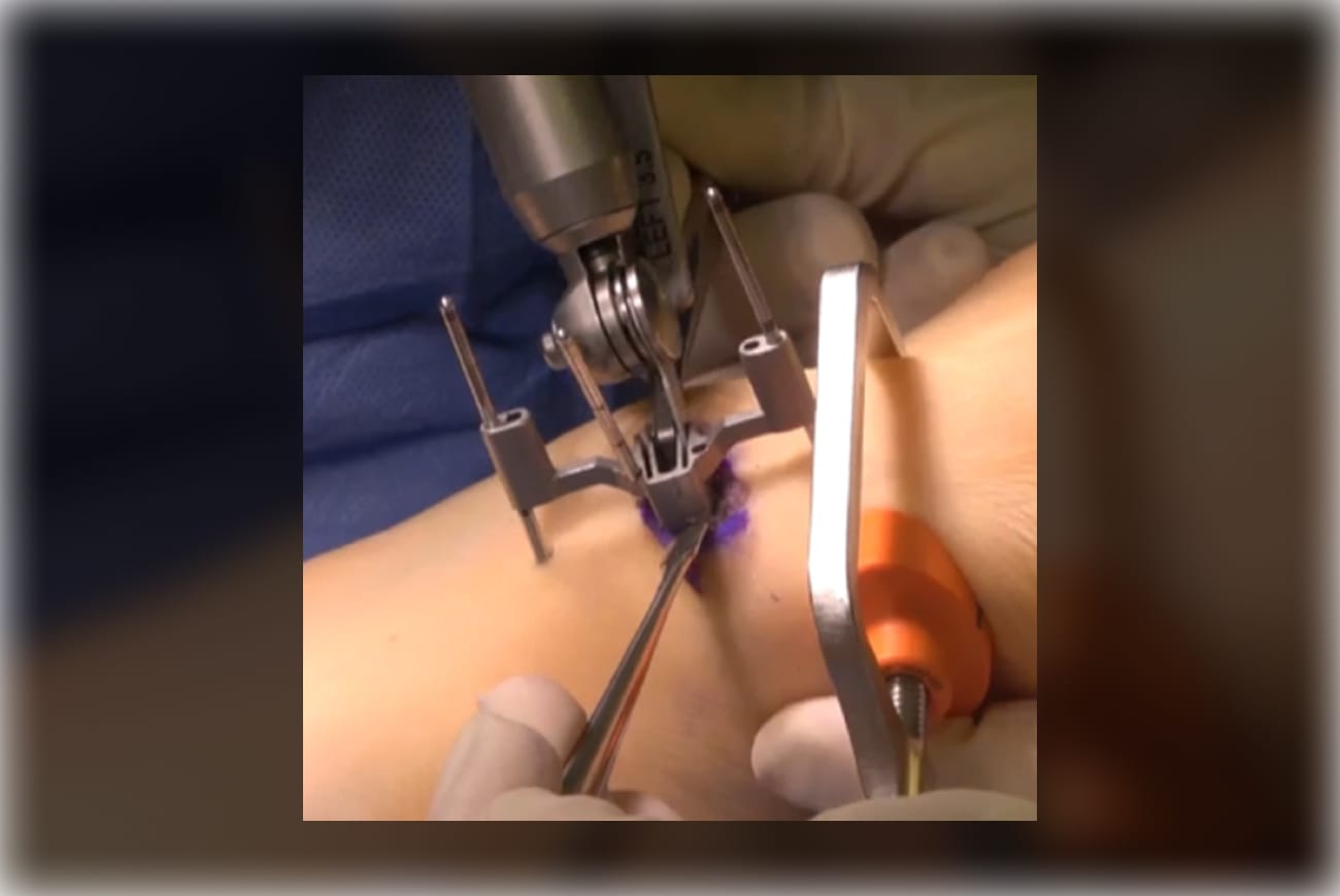 Robotic surgical device performing a delicate procedure on a patient's arm with precision instruments and tools.