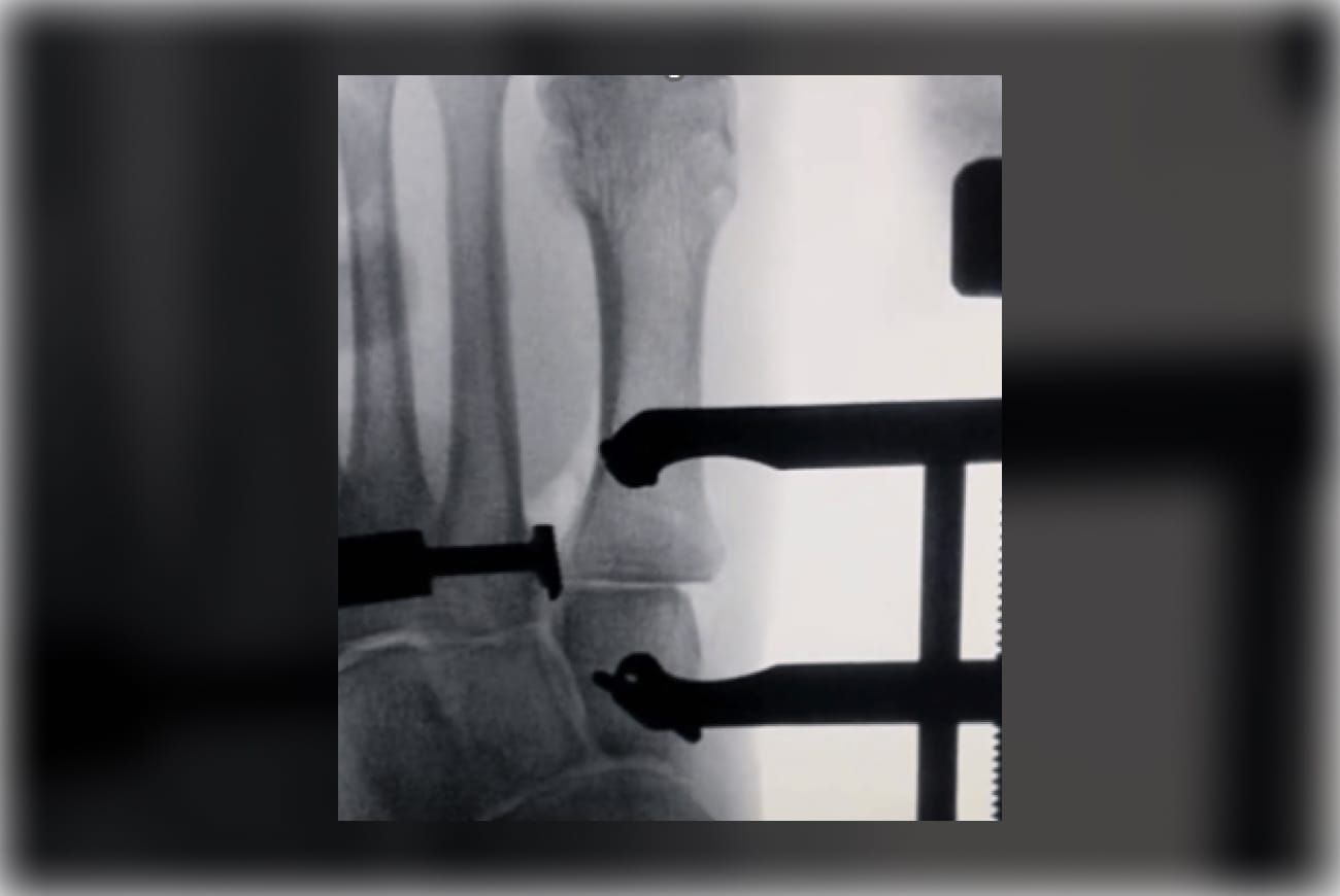 X-ray of a horse's leg during a veterinary examination, showing the positioning of surgical equipment.