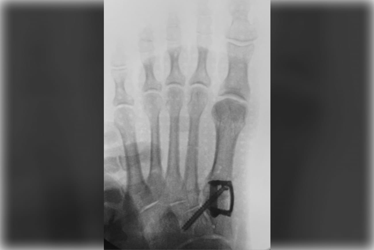 X-ray of a foot showing four toes with a visible screw near the base of the fifth toe near the heel.