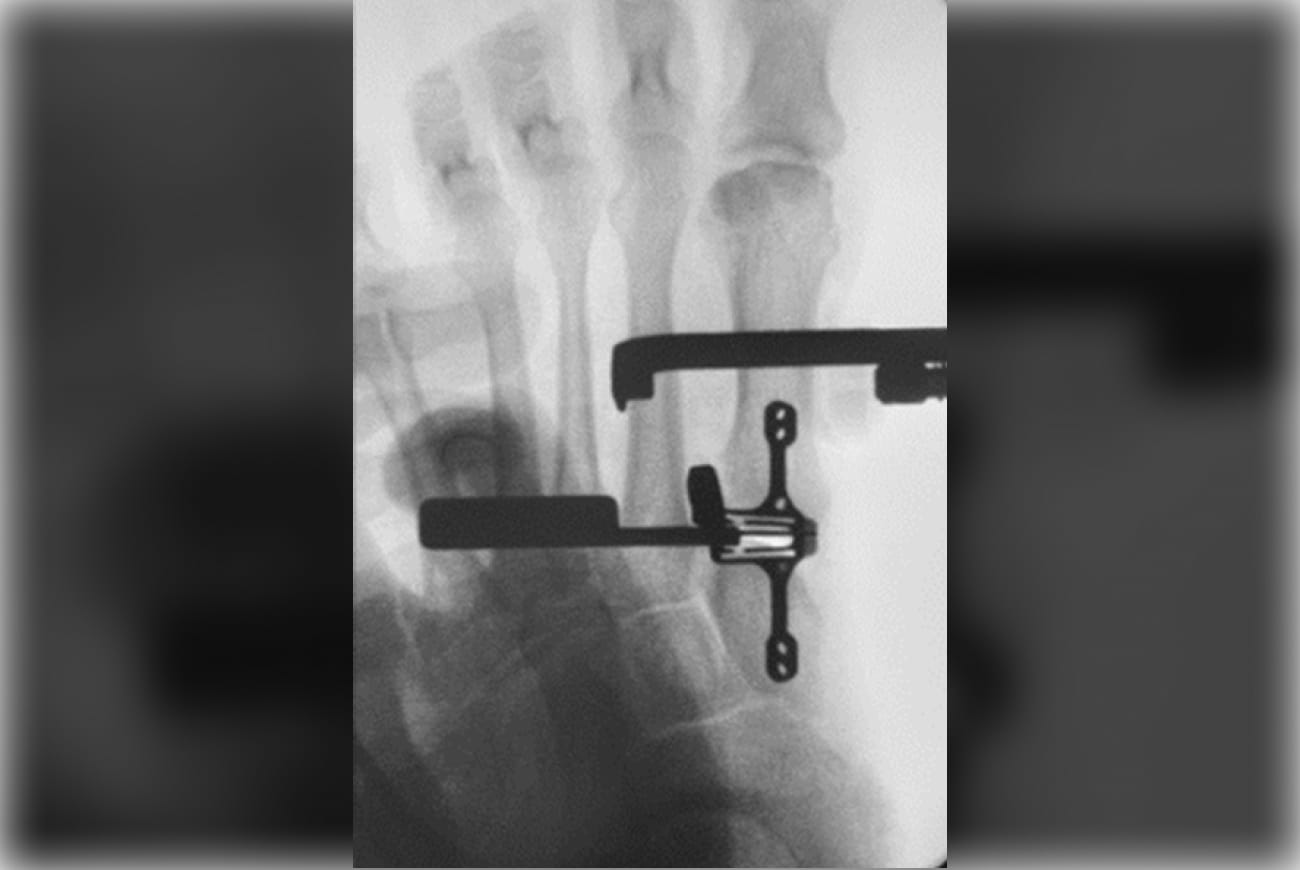 X-ray of foot showing bones and surgical hardware for medical examination or post-surgery review.