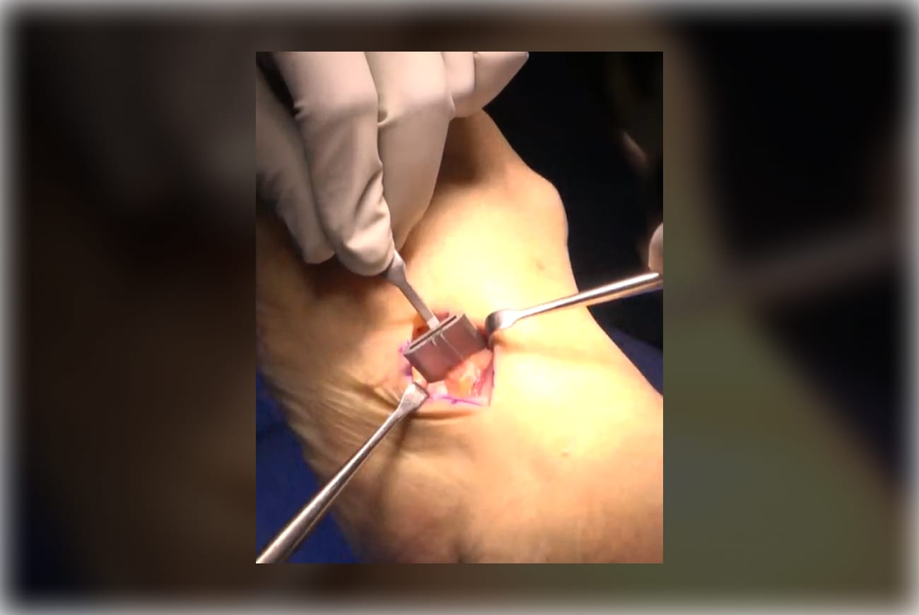 Surgical procedure on a foot with medical instruments and gloved hands in view.