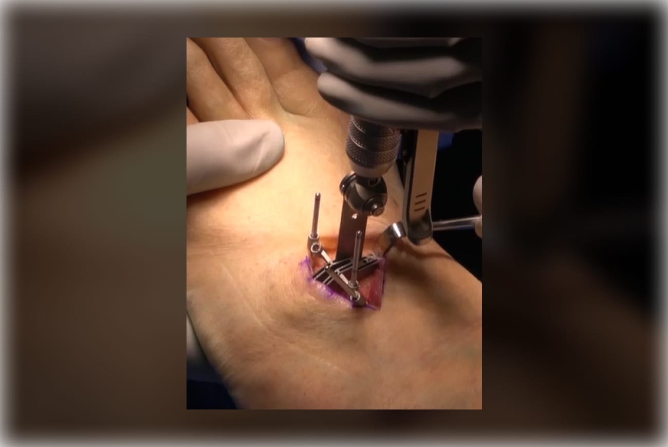 Surgical procedure on a wrist using a robotic device, with gloved hands assisting and visible incision.