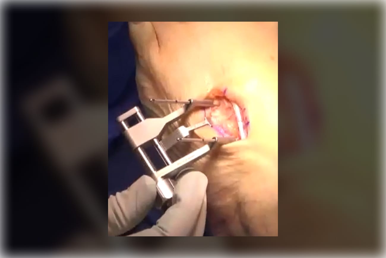 Surgical procedure being performed by a gloved hand using medical instruments on a patient's wound.