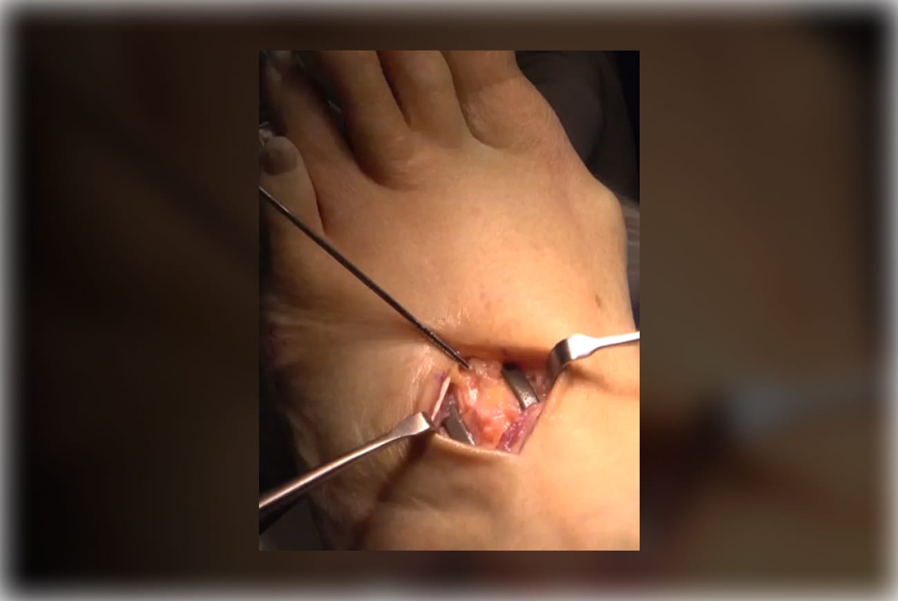 Surgical procedure on a foot with medical instruments in use, showing an open incision on the top of the foot.