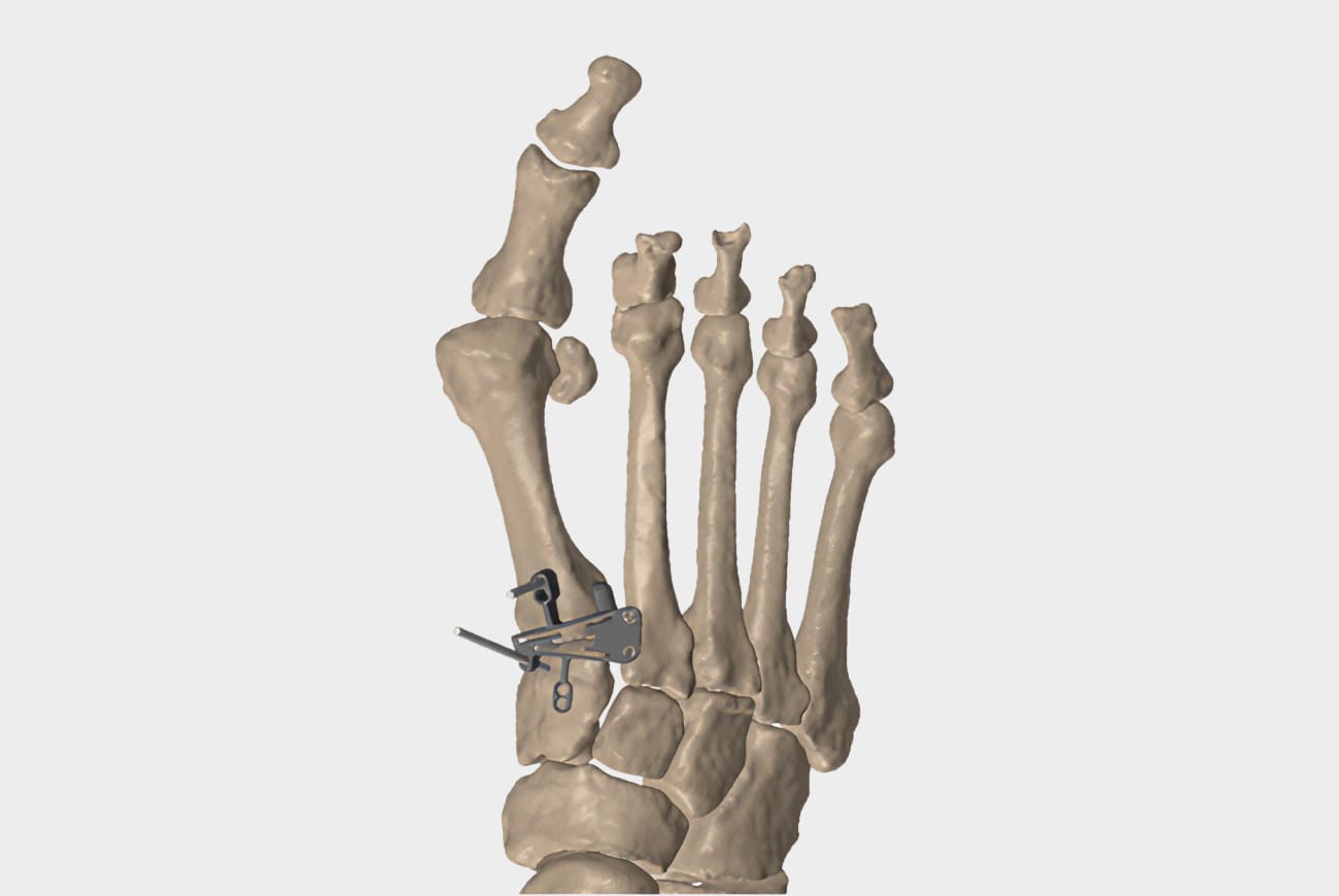 Foot bones with orthopedic implant, showing skeletal structure and medical hardware.