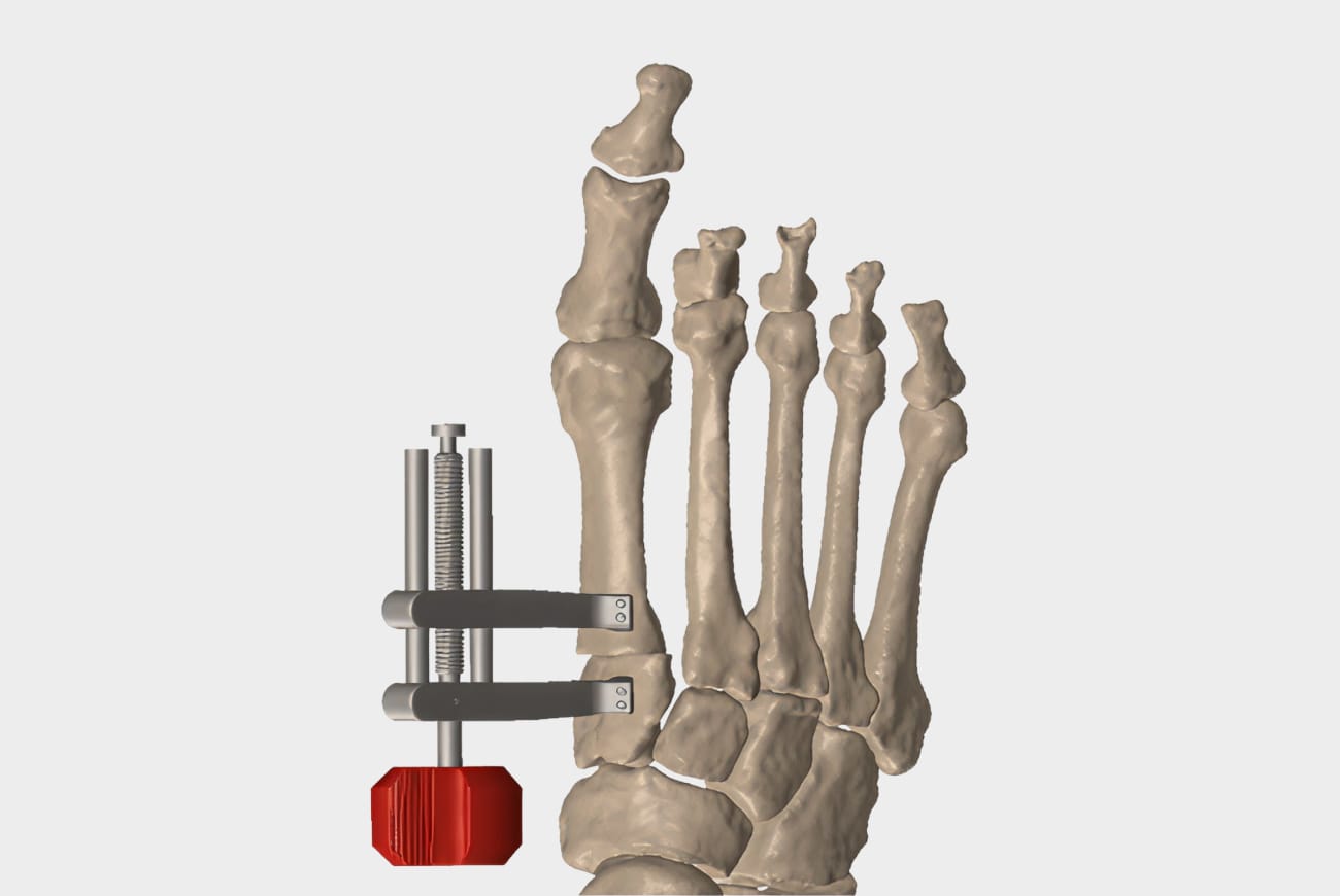 Illustration of a human foot skeleton showing surgical hardware on the first toe against a white background.