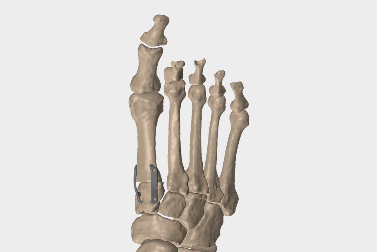 Illustration of human foot bones with a metal implant on the big toe.