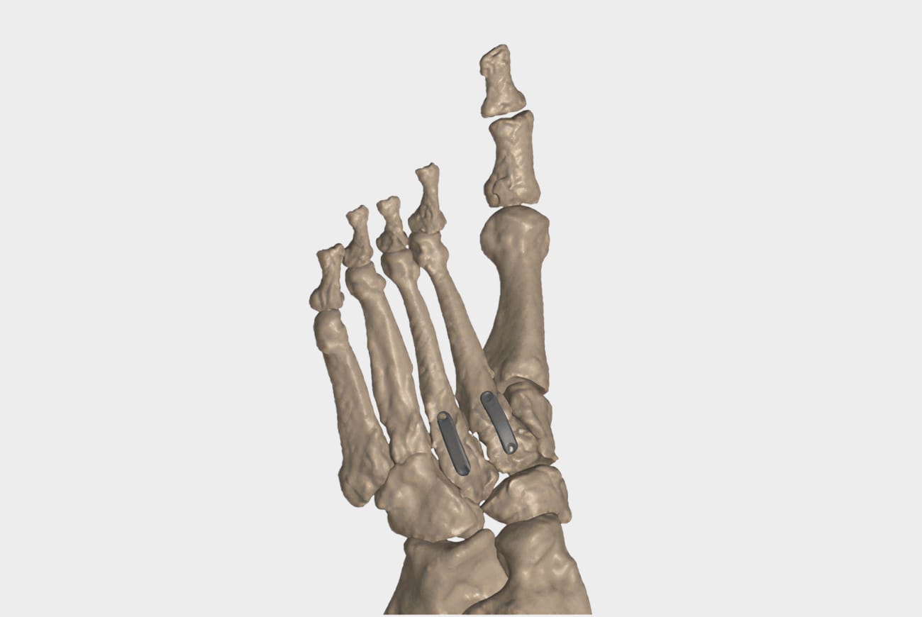 3D model of a human foot skeleton with focus on the bones of the toes and midfoot, displayed on a white background.
