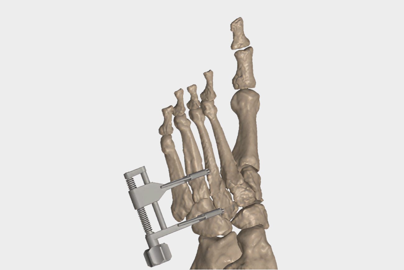 3D render of a foot skeleton with an external fixator device attached to the toes for bone alignment and stabilization.