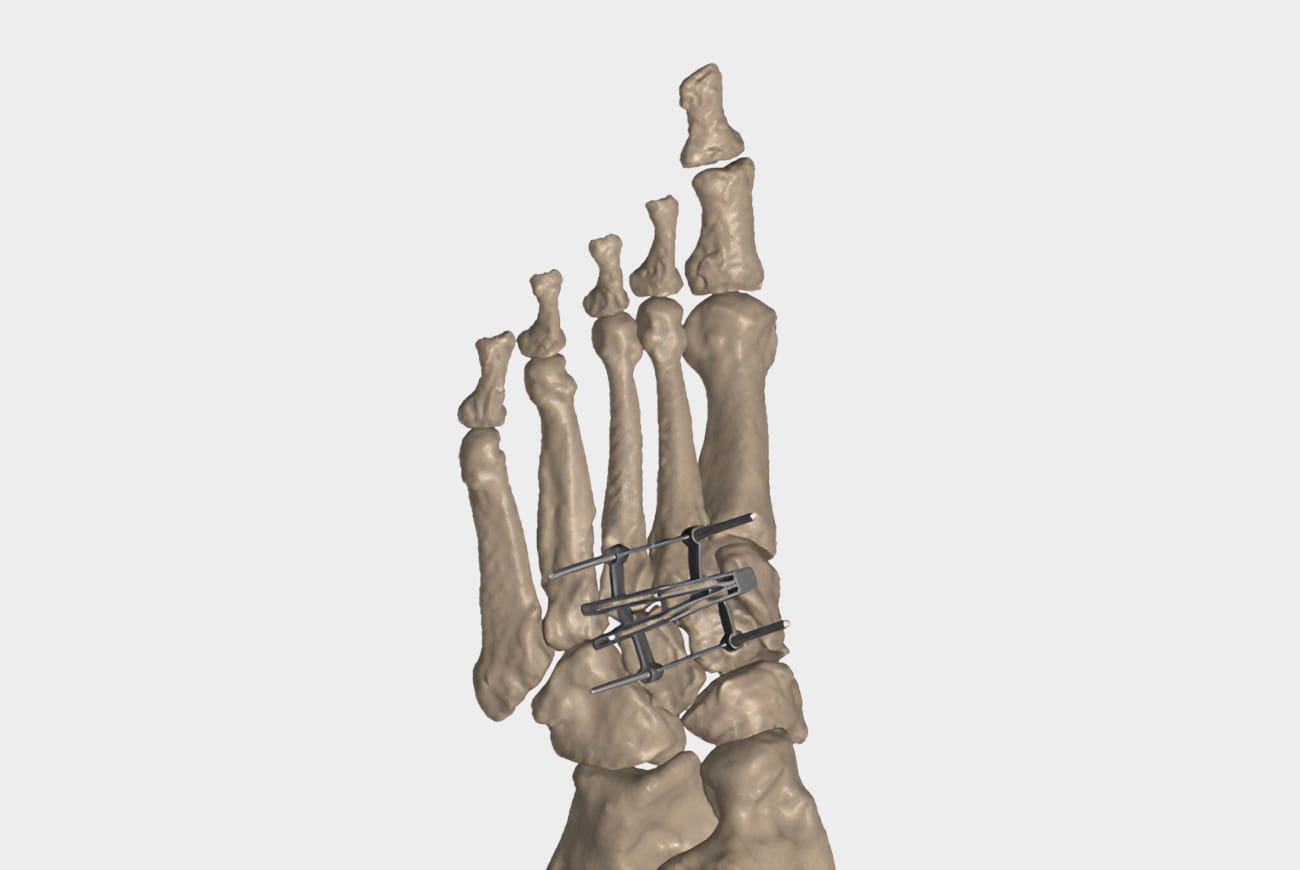 3D rendering of a foot skeleton with surgical metal plates and screws on the metatarsal and phalangeal bones, side view