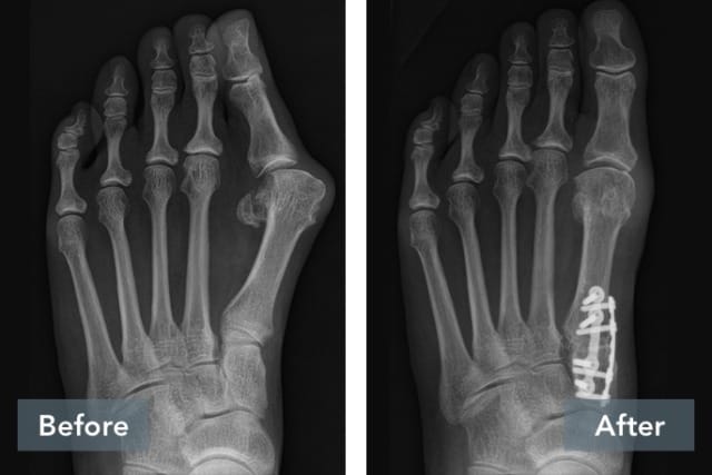 X-ray comparison of human foot before and after bunion surgery showing surgical pins and realignment of bones.