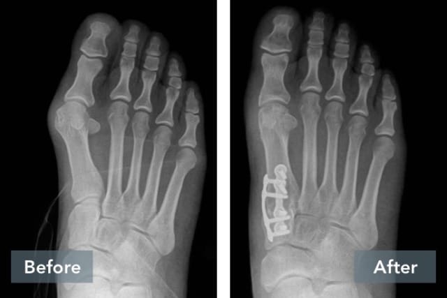 X-ray comparison showing a foot before and after surgery with metallic screws in bones.