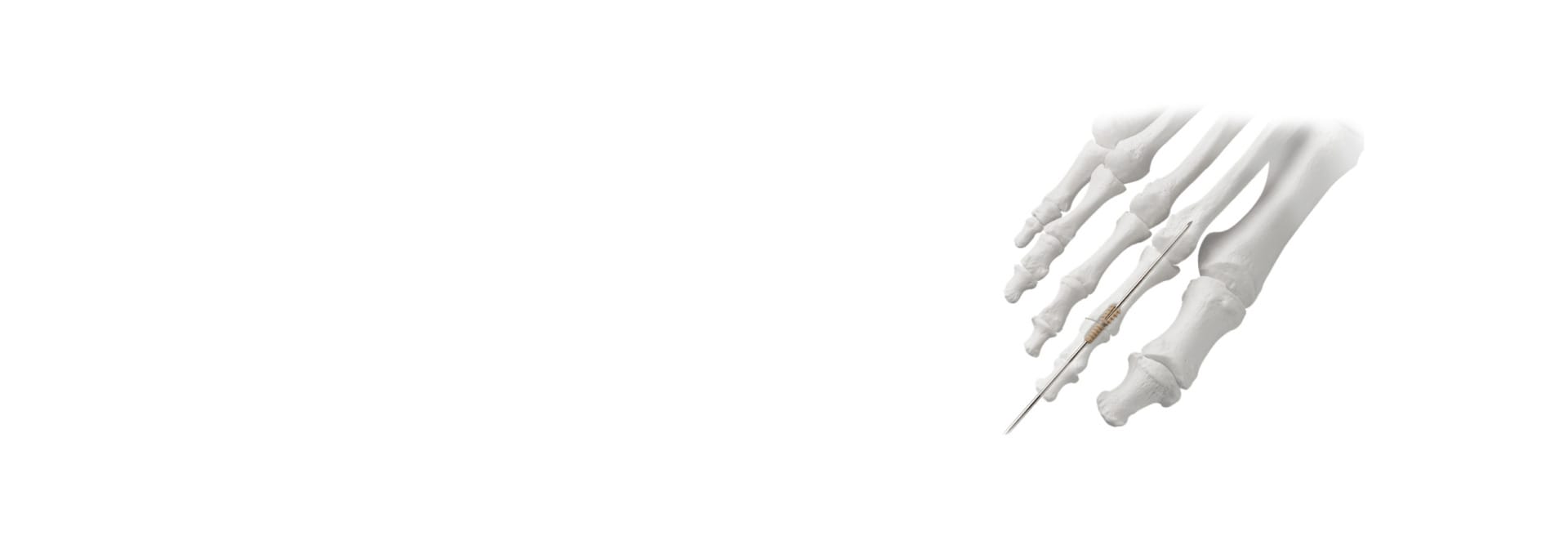 Illustration of foot bones with a focus on a needle inserted into a joint, emphasizing medical treatment or procedure.