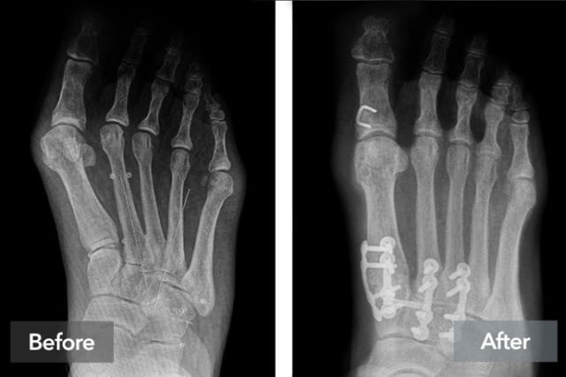 X-ray showing a foot before and after surgical correction, with visible screws and plates used for stabilization.