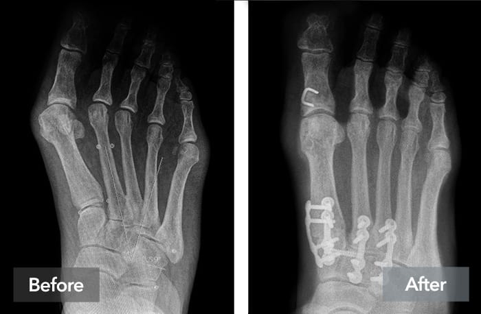 X-ray showing a foot before and after surgical correction, with visible screws and plates used for stabilization.