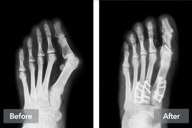 X-rays of a foot showing bones before and after surgery with screws and plates.