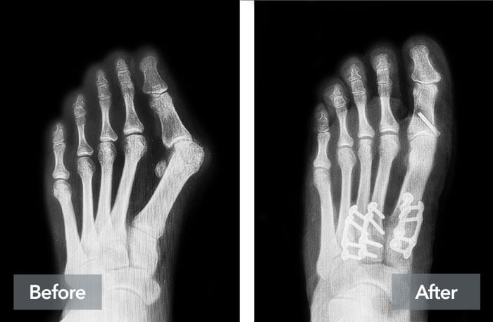 X-rays of a foot showing bones before and after surgery with screws and plates.