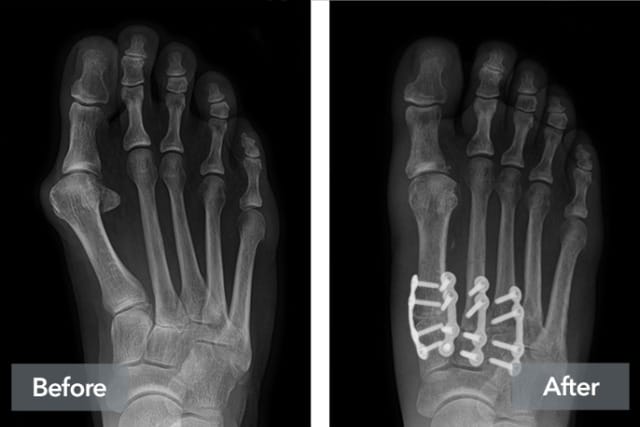 X-ray comparison of a foot before and after surgery, with screws visible in the after image.