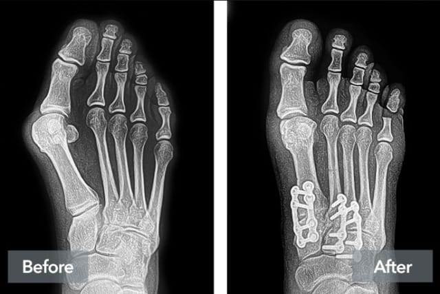X-ray images of a foot before and after surgery showing bone alignment and inserted screws.