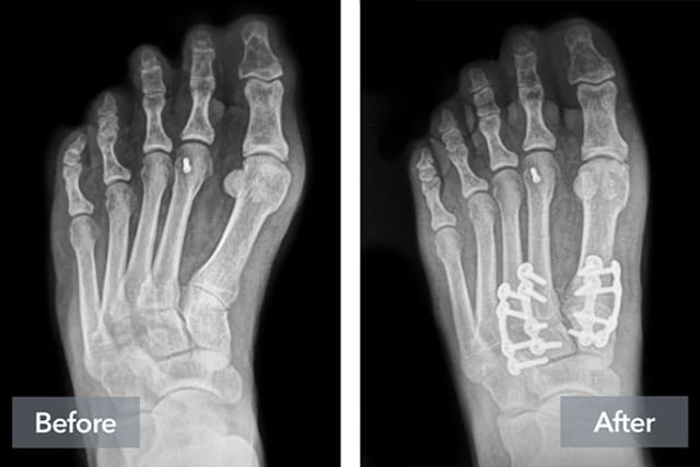 X-ray of a foot showing before and after views of corrective surgery with metal plates and screws.