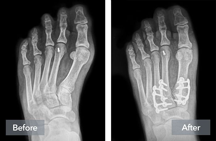 X-ray of a foot showing before and after views of corrective surgery with metal plates and screws.