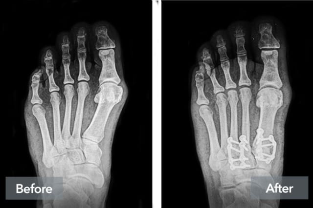 Before and after X-ray images of a foot showing surgical intervention with metal plates and screws.