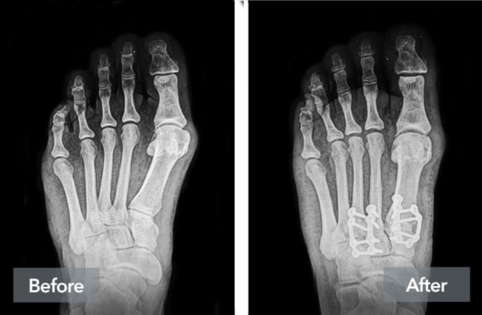 Before and after X-ray images of a foot showing surgical intervention with metal plates and screws.