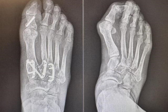 X-ray of human feet, one with surgical screws and plate in place, showing bones and implanted medical hardware.