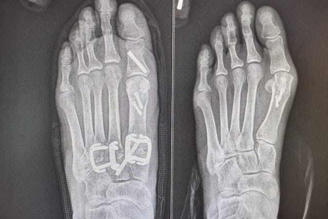 X-ray image of a foot showing metal screws and plates on bones from a surgical procedure, with toes and metatarsals visible.