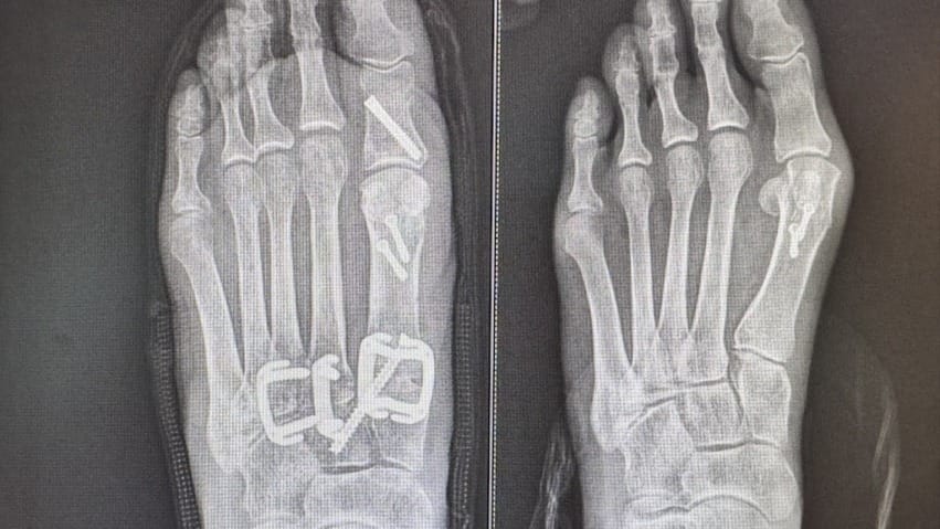X-ray image of a foot showing metal screws and plates on bones from a surgical procedure, with toes and metatarsals visible.
