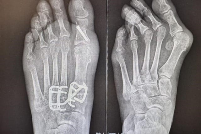 X-ray of a foot with orthopedic screws and plates, showing bones and surgical hardware for fracture repair.
