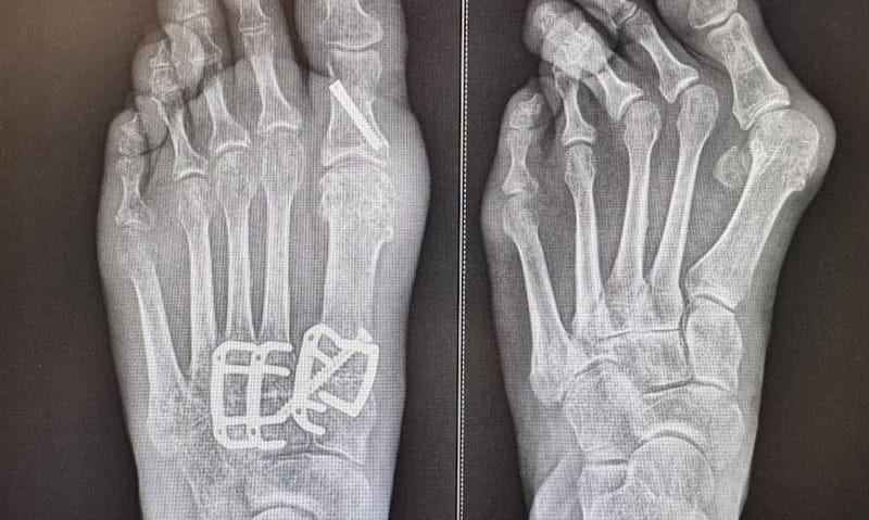 X-ray of a foot with orthopedic screws and plates, showing bones and surgical hardware for fracture repair.