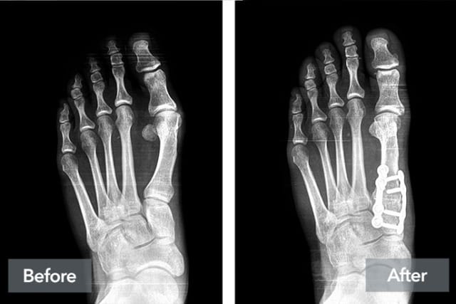 Before and after X-ray of a foot with surgical repair, showing bone correction and metal plates for stabilization.