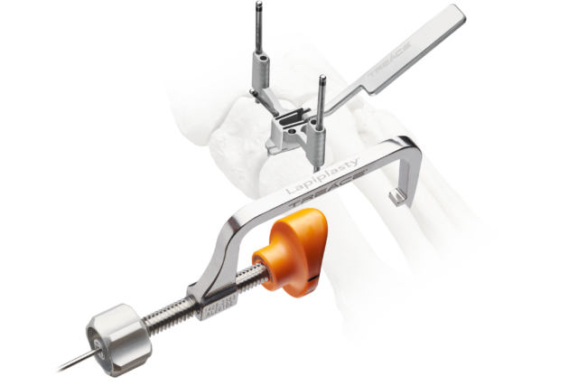 medical tool used in orthopedic surgery with screws and clamp against a skeletal foot model