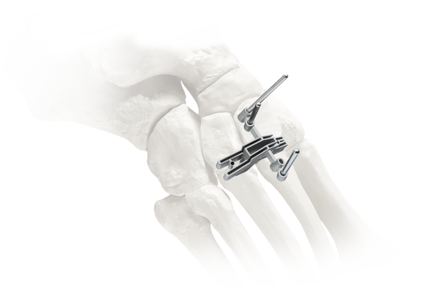 Medical illustration of a foot skeleton with metal bone plates and screws for orthopedic surgery or fracture fixation