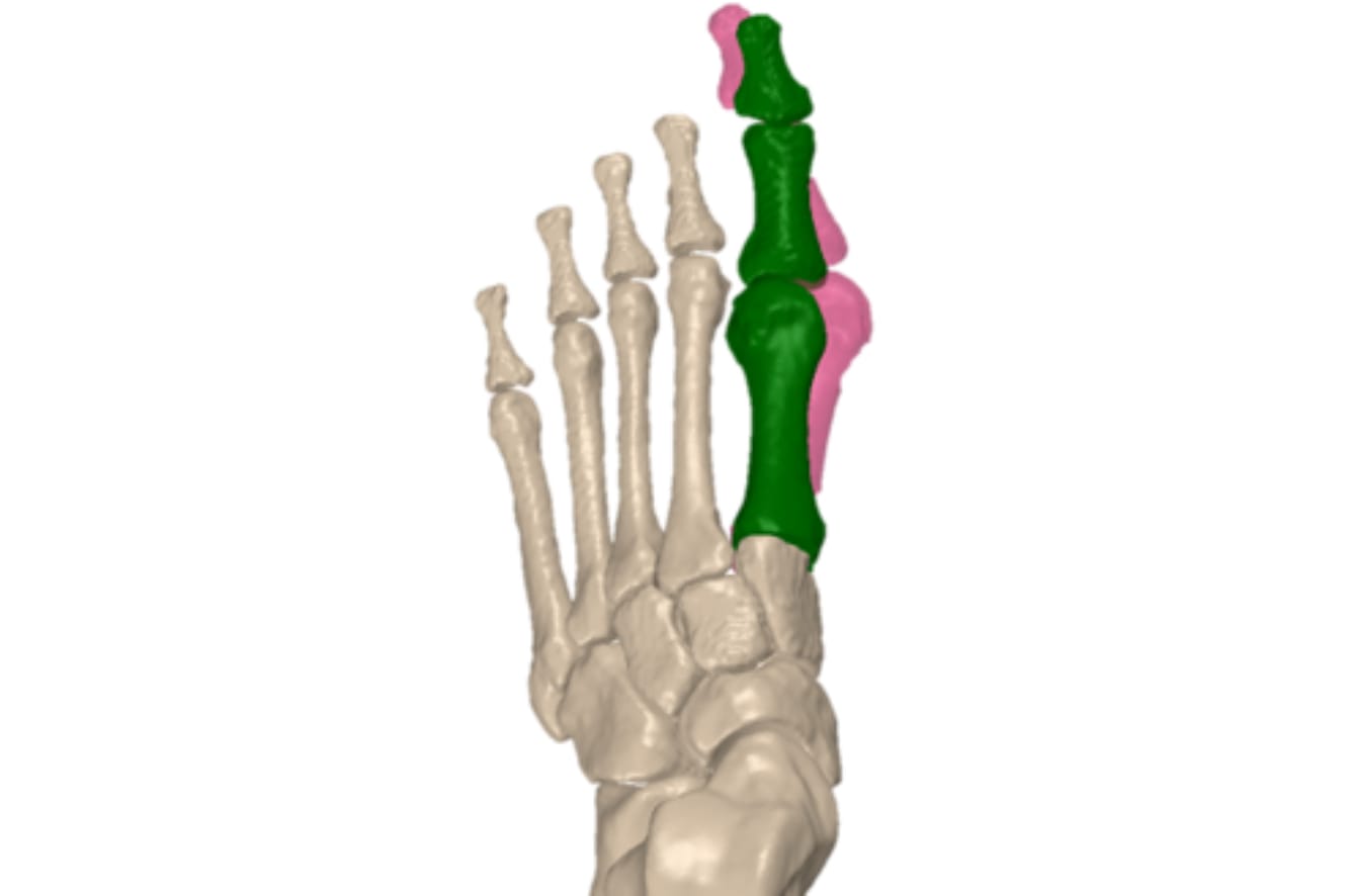 Illustration of a human foot bone with highlighted green and pink phalanges on the second and third toes, showing bone structures.